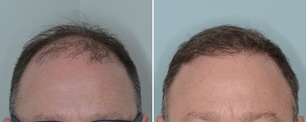 Hair Transplant before and after, frontal.