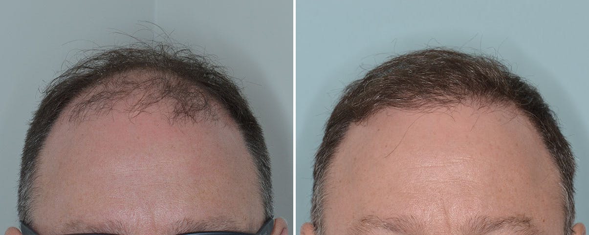Hair Transplant before and after, frontal.