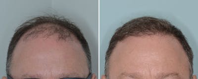 Hair Transplant before and after, frontal.