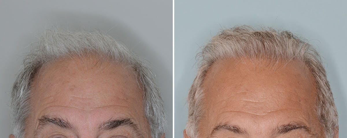 Hair Transplant before and after, frontal.