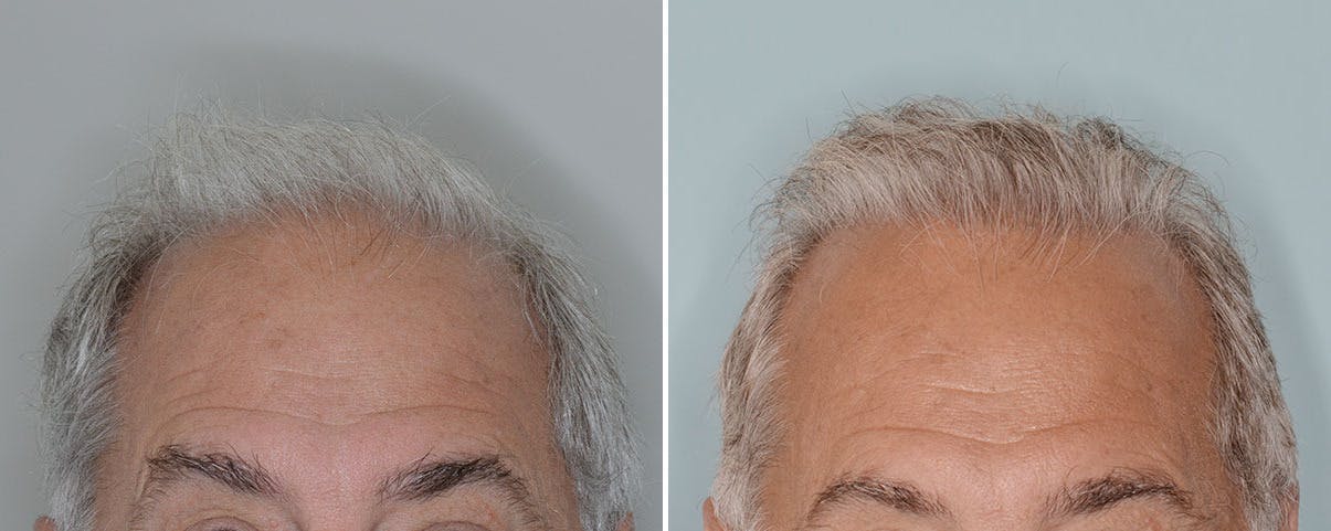 Hair Transplant before and after, frontal.