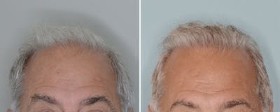 Hair Transplant before and after, frontal.