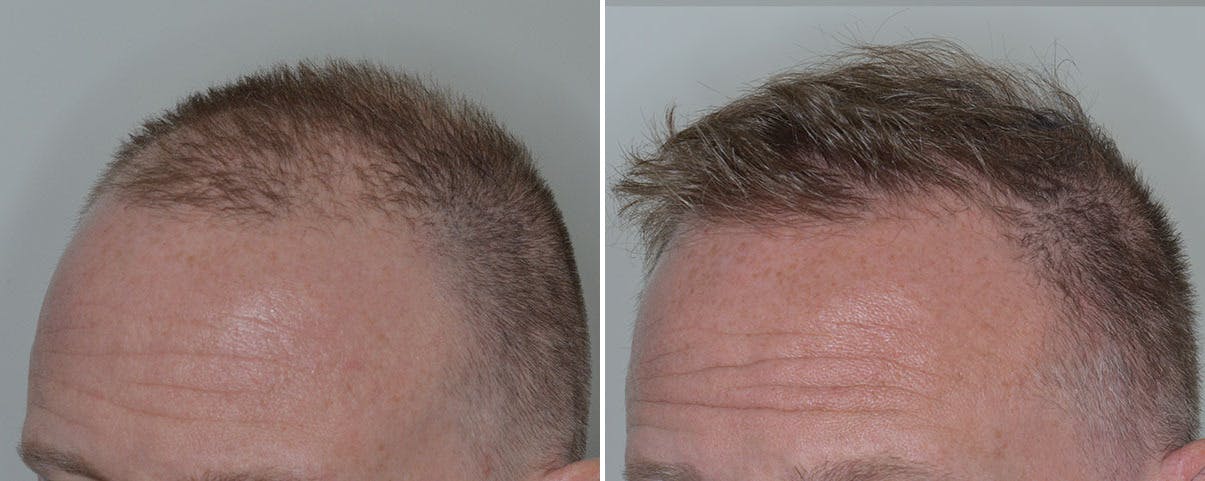 Hair Transplant before and after, oblique left.