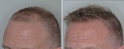 Hair Transplant before and after, oblique left.