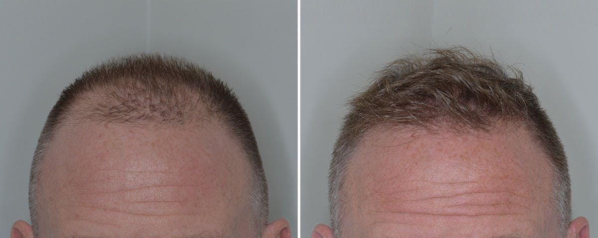 Hair Transplant before and after, frontal.