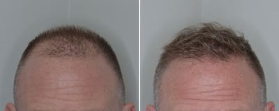 Hair Transplant before and after, frontal.
