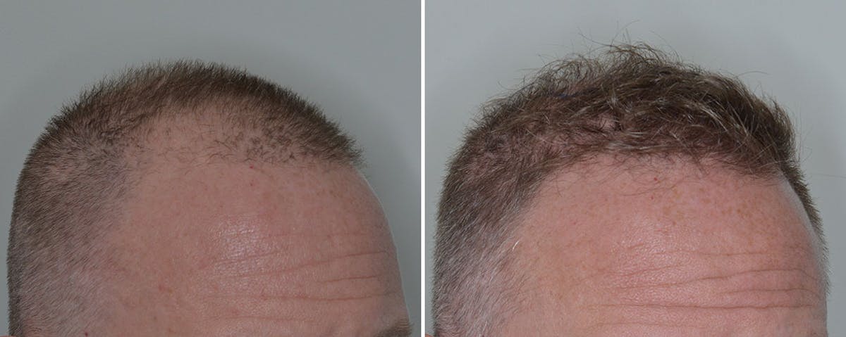 Hair Transplant before and after, oblique right.