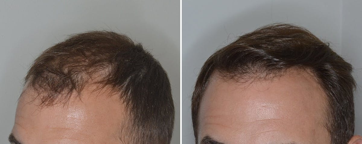 Hair Transplant before and after, oblique left.