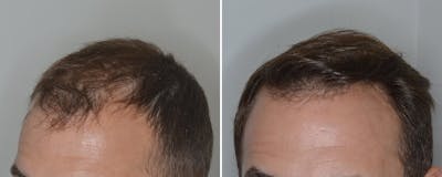 Hair Transplant before and after, oblique left.
