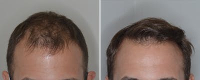 Hair Transplant before and after, frontal.