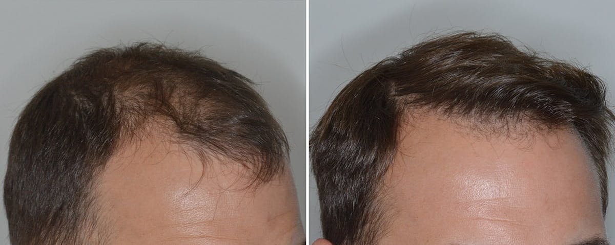 Hair Transplant before and after, oblique right.