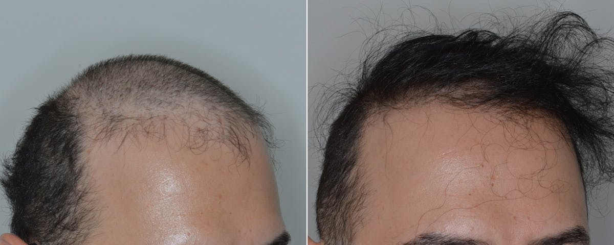 Hair Transplant before and after, oblique right.
