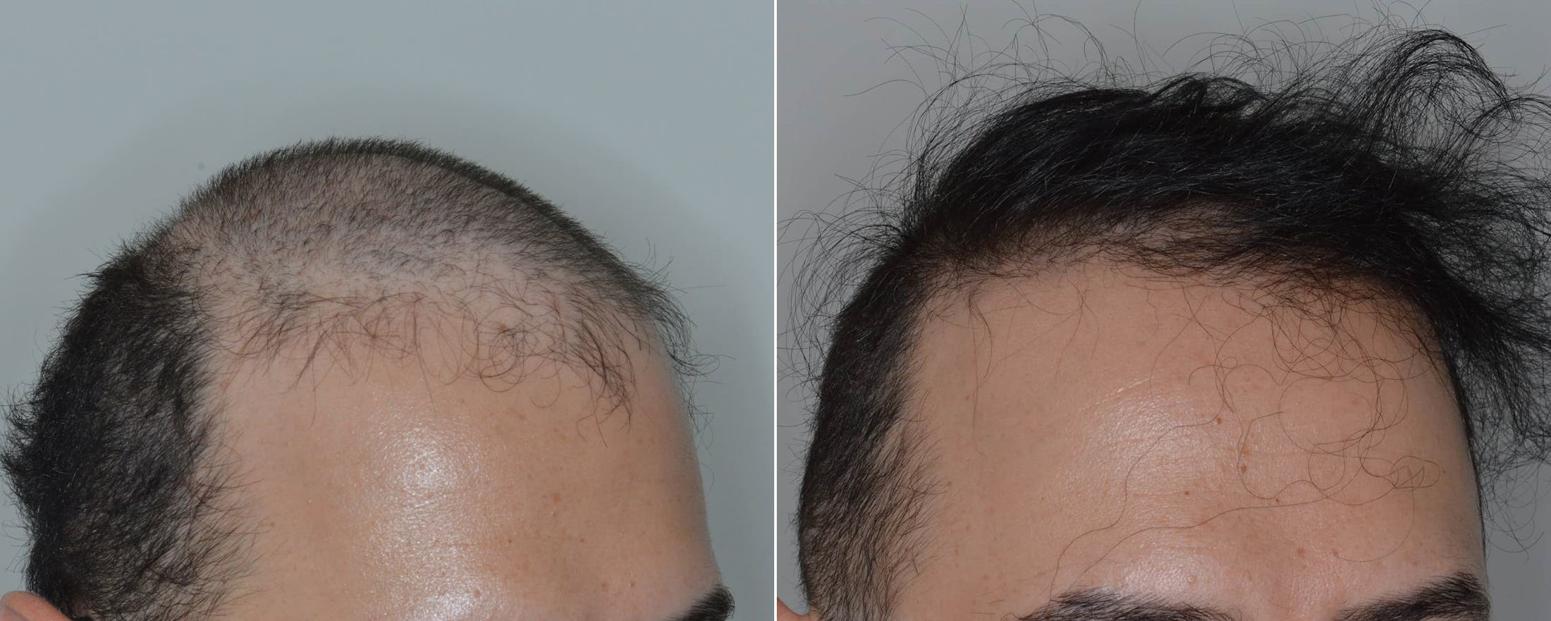 Hair Transplant before and after, oblique right.