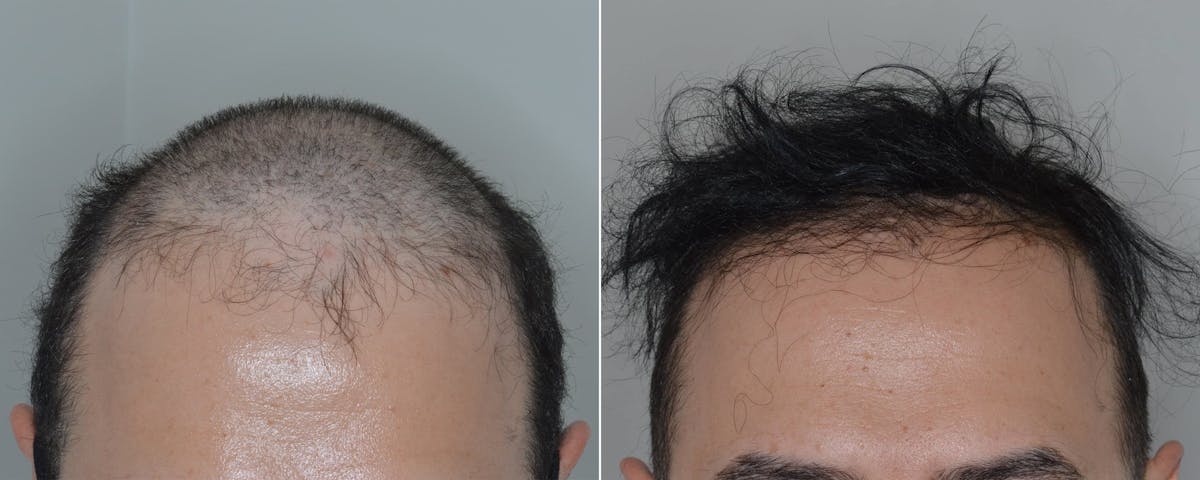 Hair Transplant before and after, frontal.