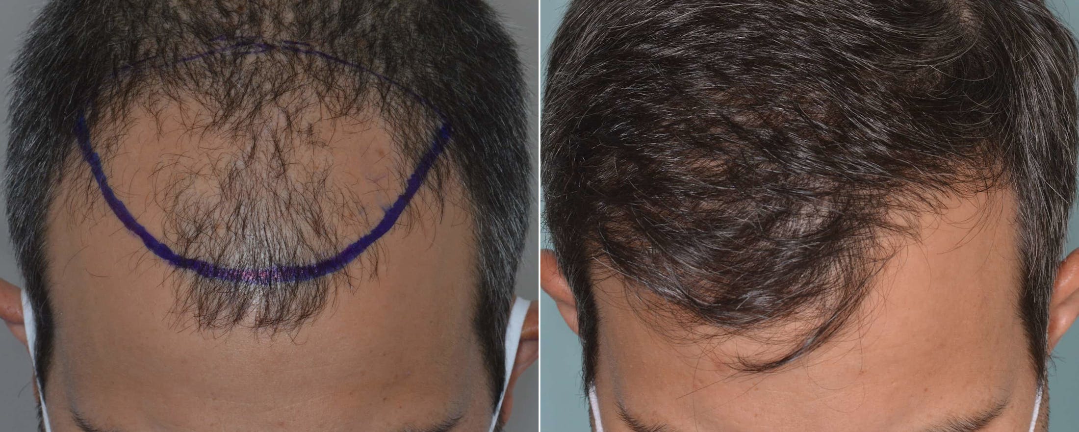 Hair Transplant before and after, frontal.