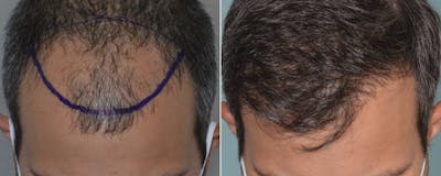 Hair Transplant before and after, frontal.