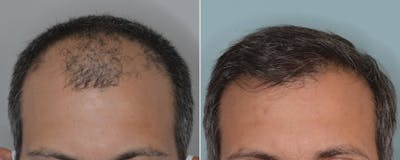 Hair Transplant before and after, frontal.
