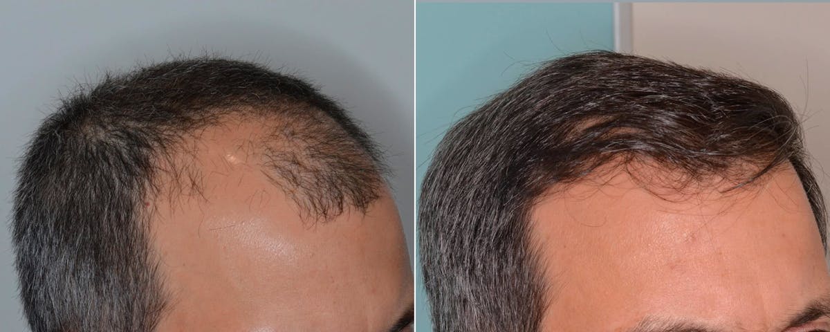 Hair Transplant before and after, oblique right.