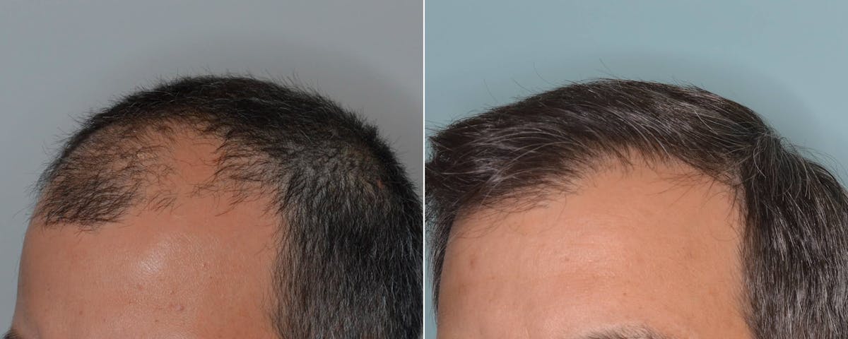 Hair Transplant before and after, oblique left.