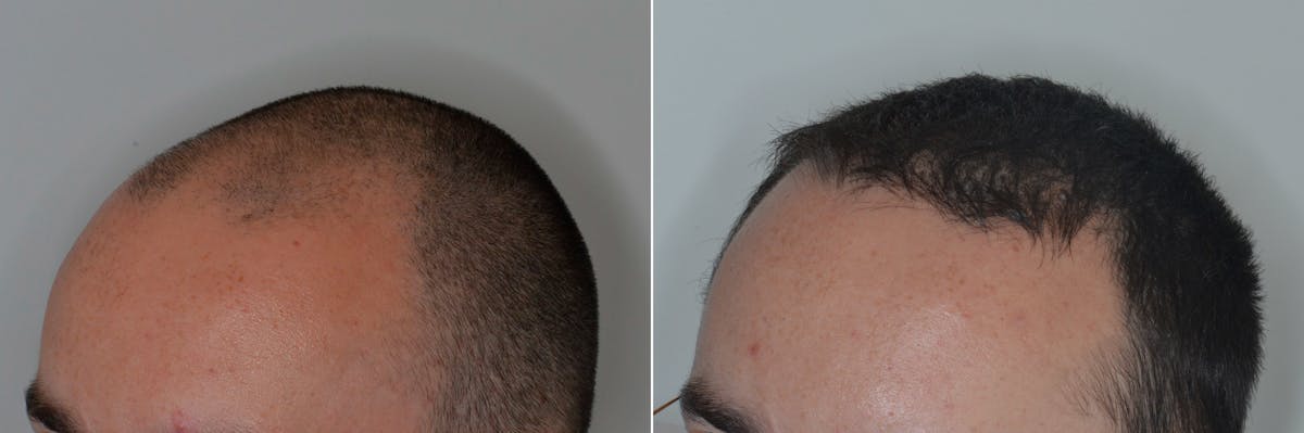 Hair Transplant before and after, oblique left.