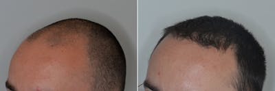 Hair Transplant before and after, oblique left.