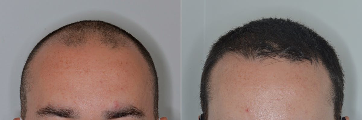 Hair Transplant before and after, frontal.