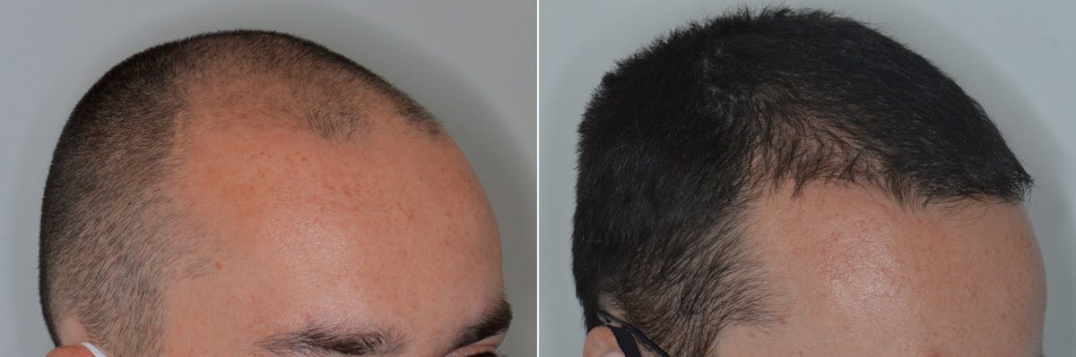 Hair Transplant before and after, oblique right.