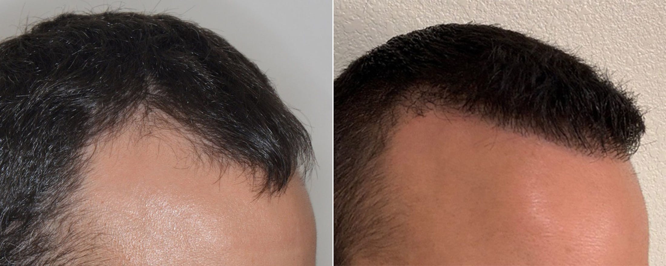 Hair Transplant before and after, oblique right.
