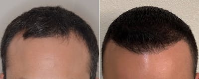 Hair Transplant before and after, frontal.
