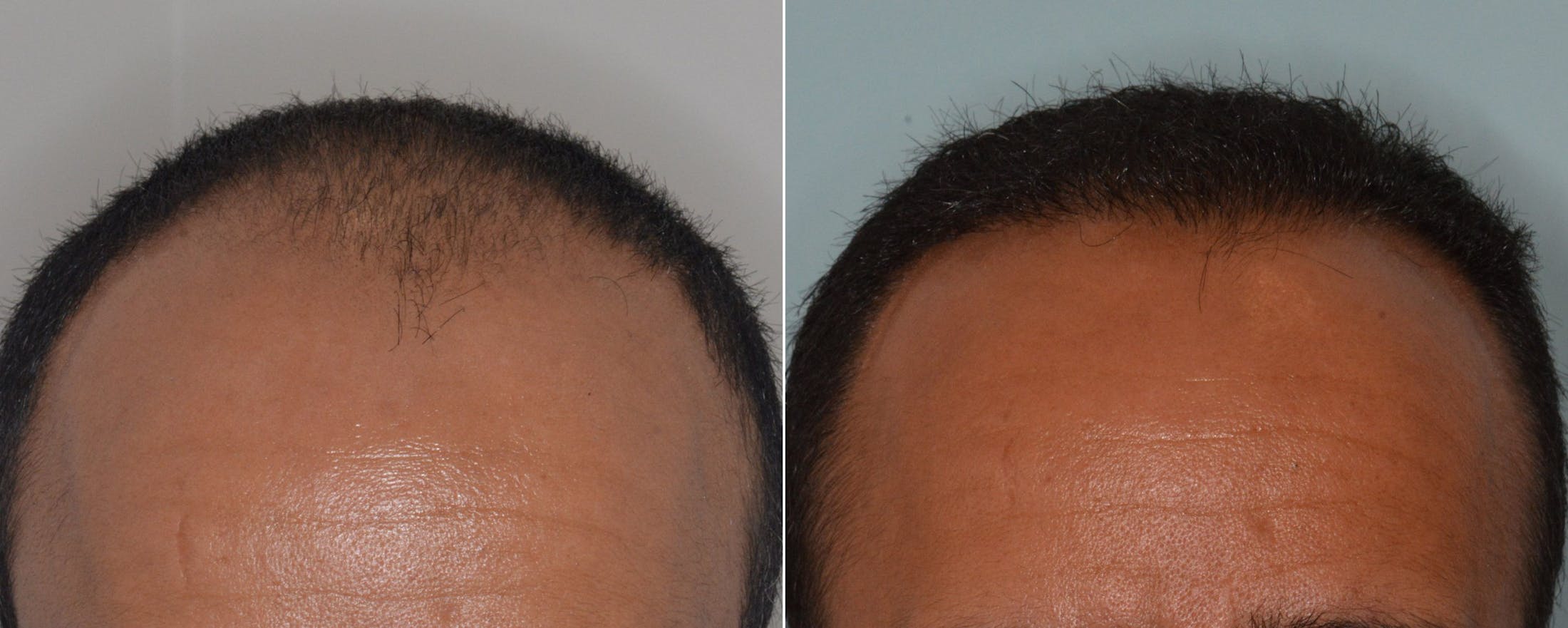 Hair Transplant before and after, frontal.