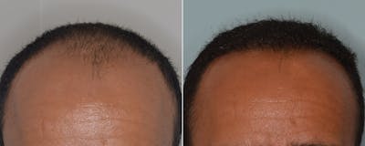 Hair Transplant before and after, frontal.