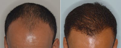 Hair Transplant before and after, frontal.