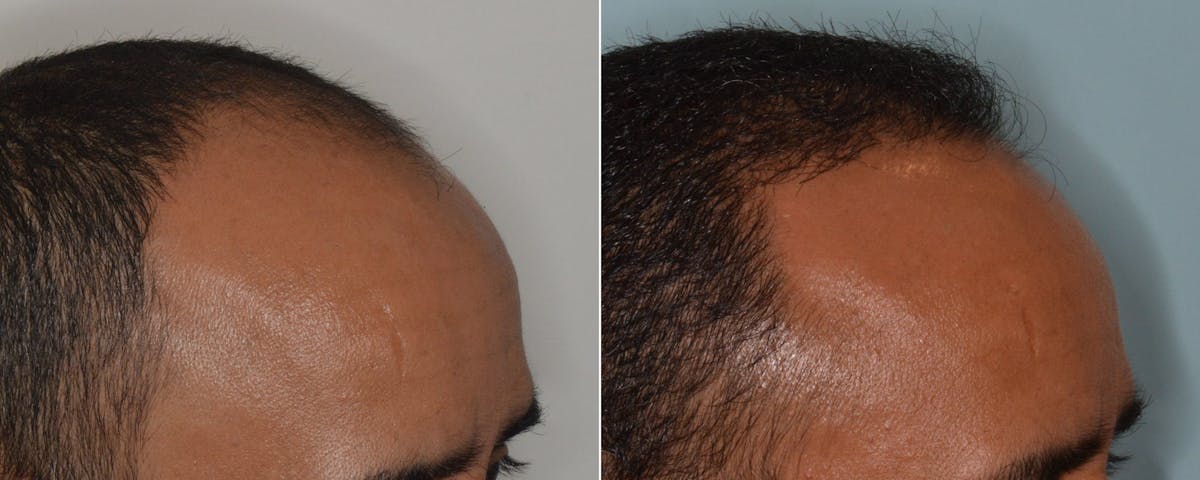 Hair Transplant before and after, lateral right.