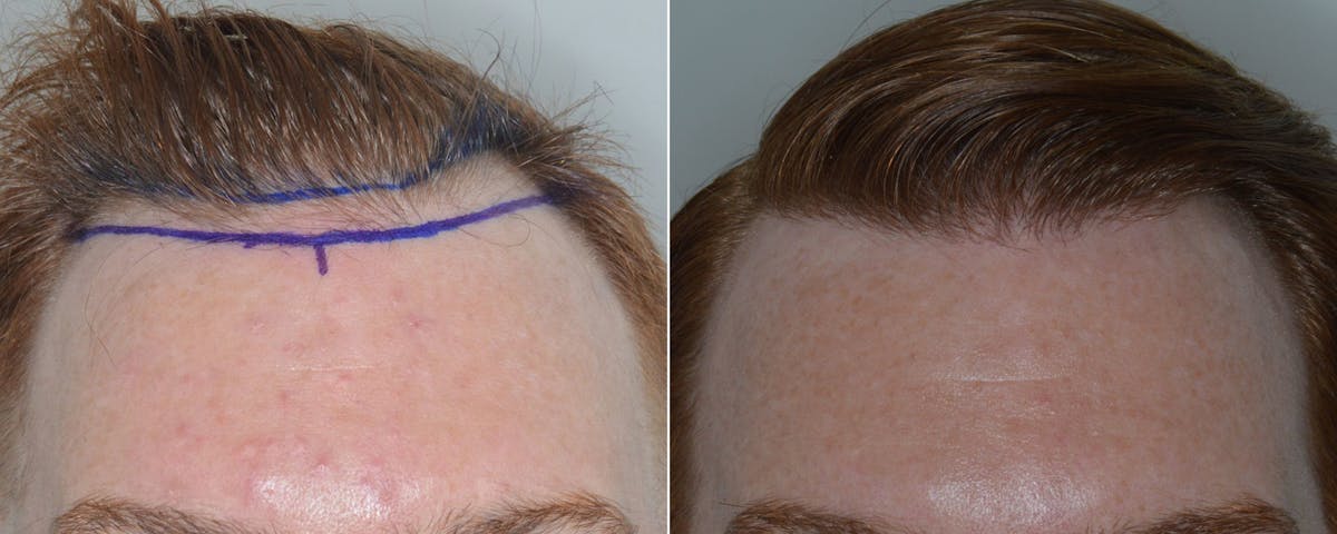 Hair Transplant before and after, marked.
