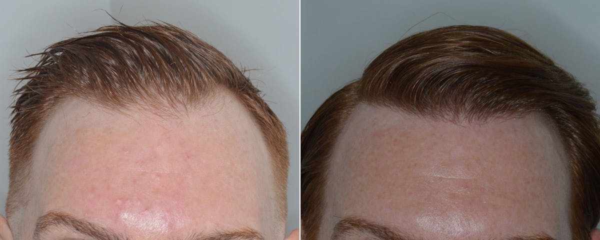 Hair Transplant before and after, frontal.