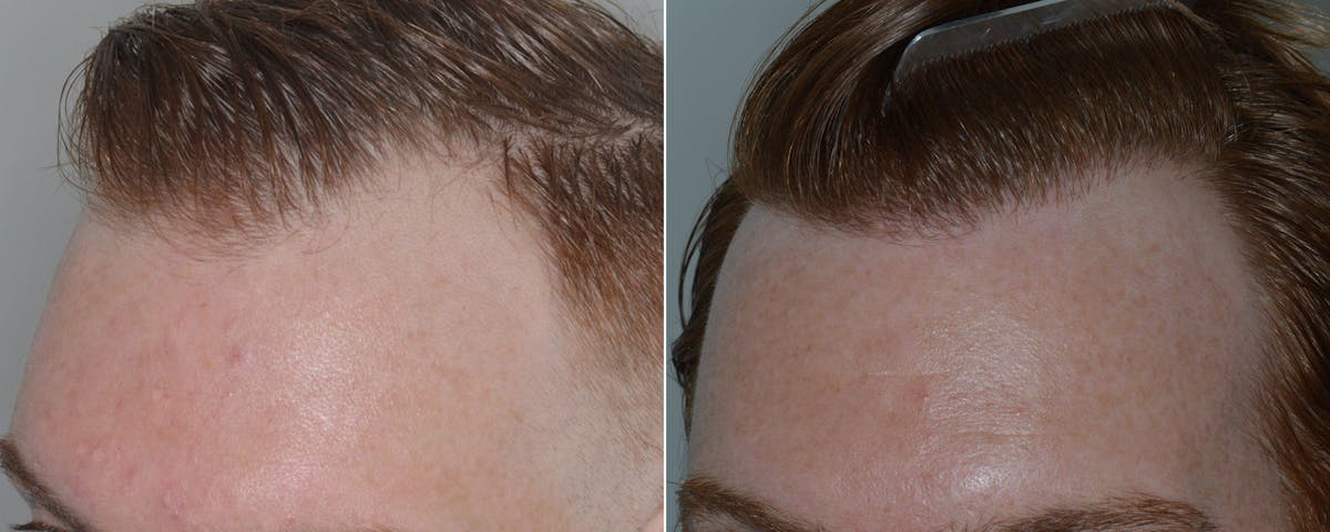 Hair Transplant before and after, oblique left.