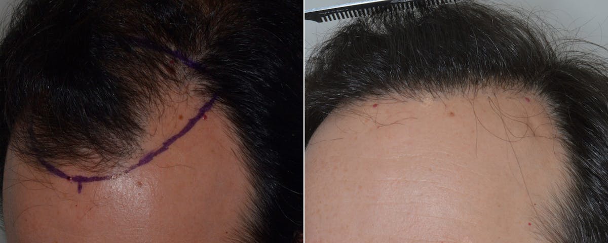 Hair Transplant before and after, frontal.
