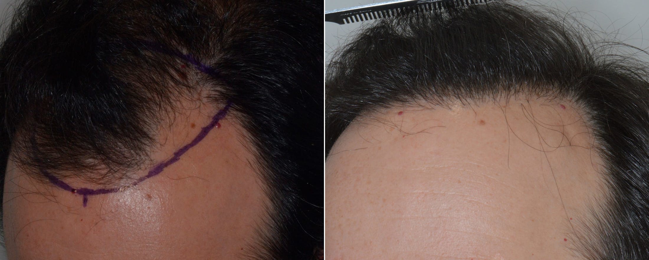 Hair Transplant before and after, frontal.