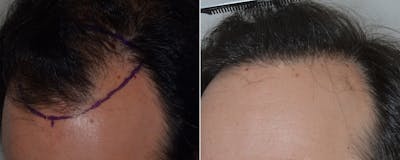 Hair Transplant before and after, frontal.