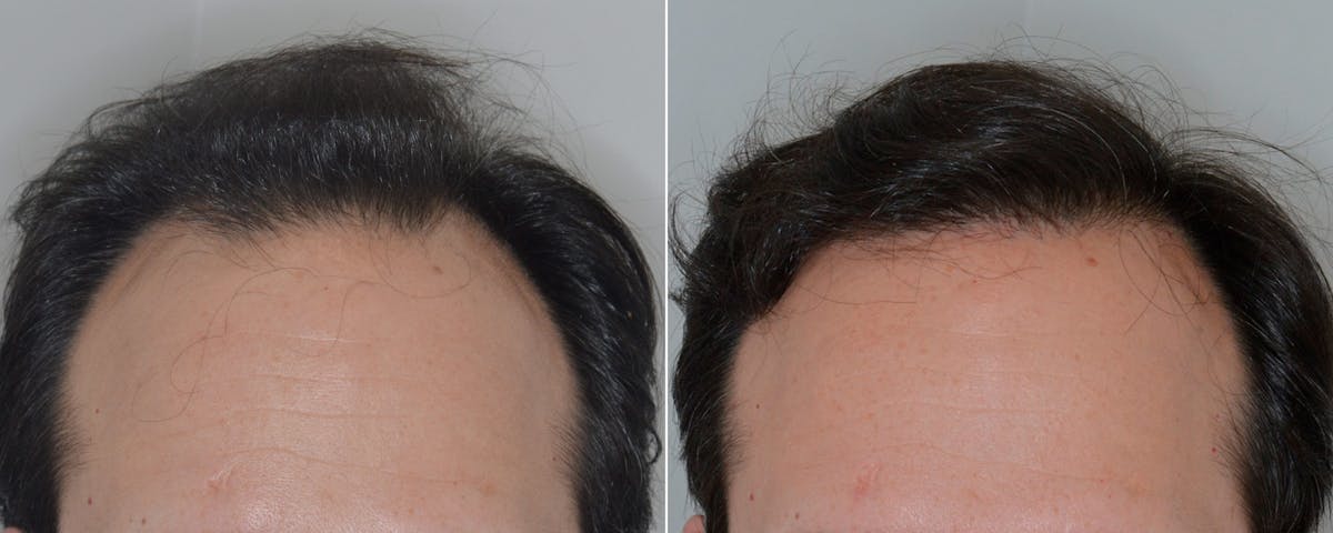 Hair Transplant before and after, frontal.