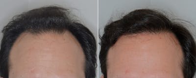 Hair Transplant before and after, frontal.