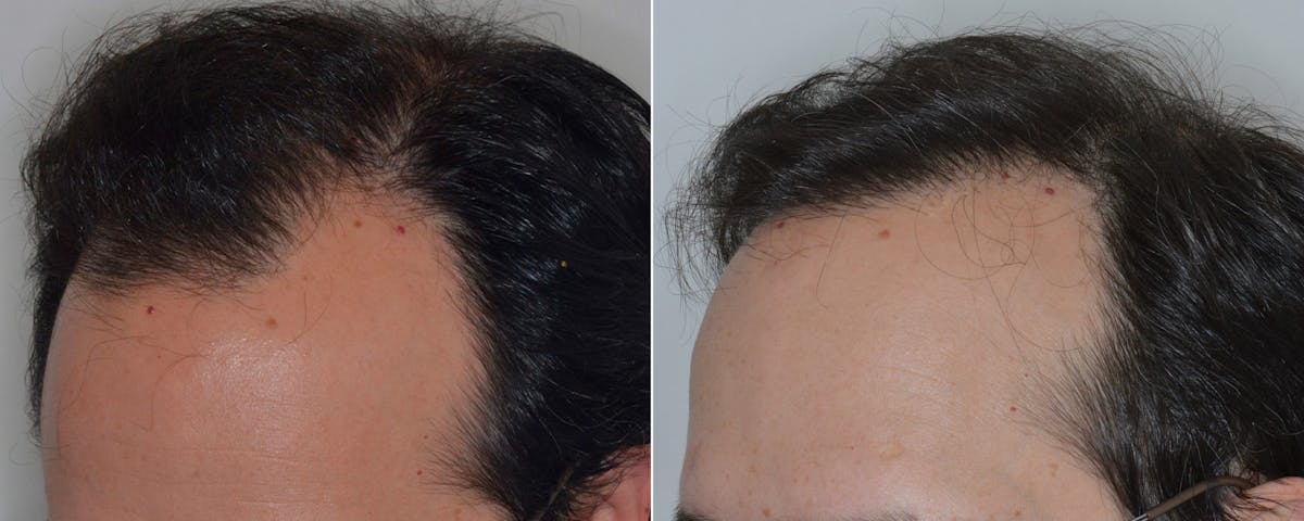Hair Transplant before and after, oblique left.