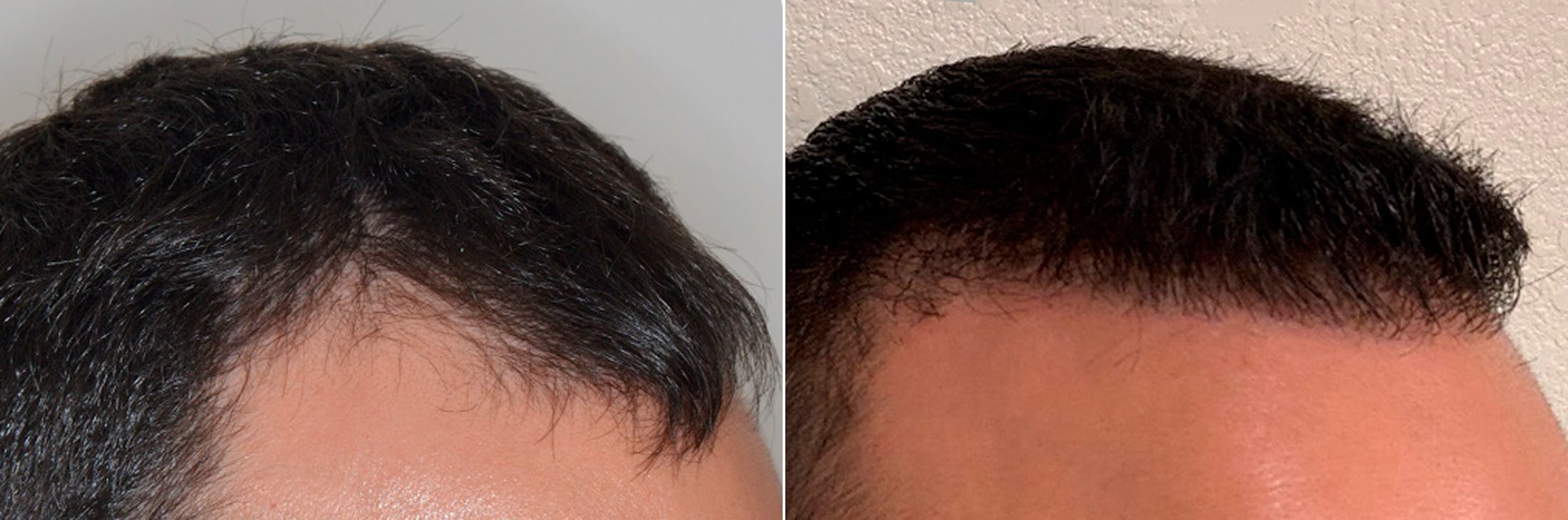 Hair Transplant before and after, oblique right.