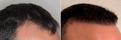 Hair Transplant before and after, oblique right.