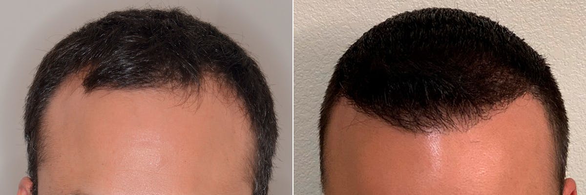 Hair Transplant before and after, frontal.