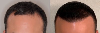 Hair Transplant before and after, frontal.