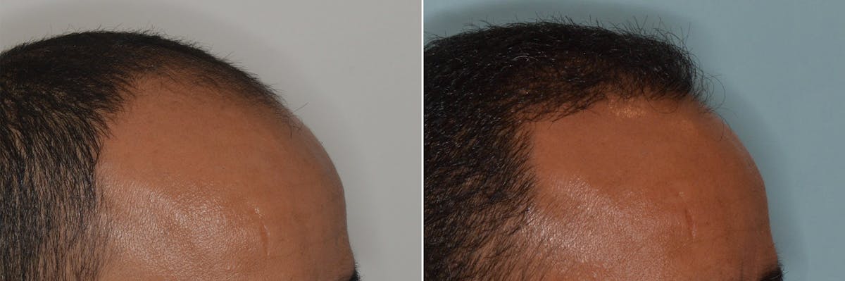 Hair Transplant before and after, oblique right.