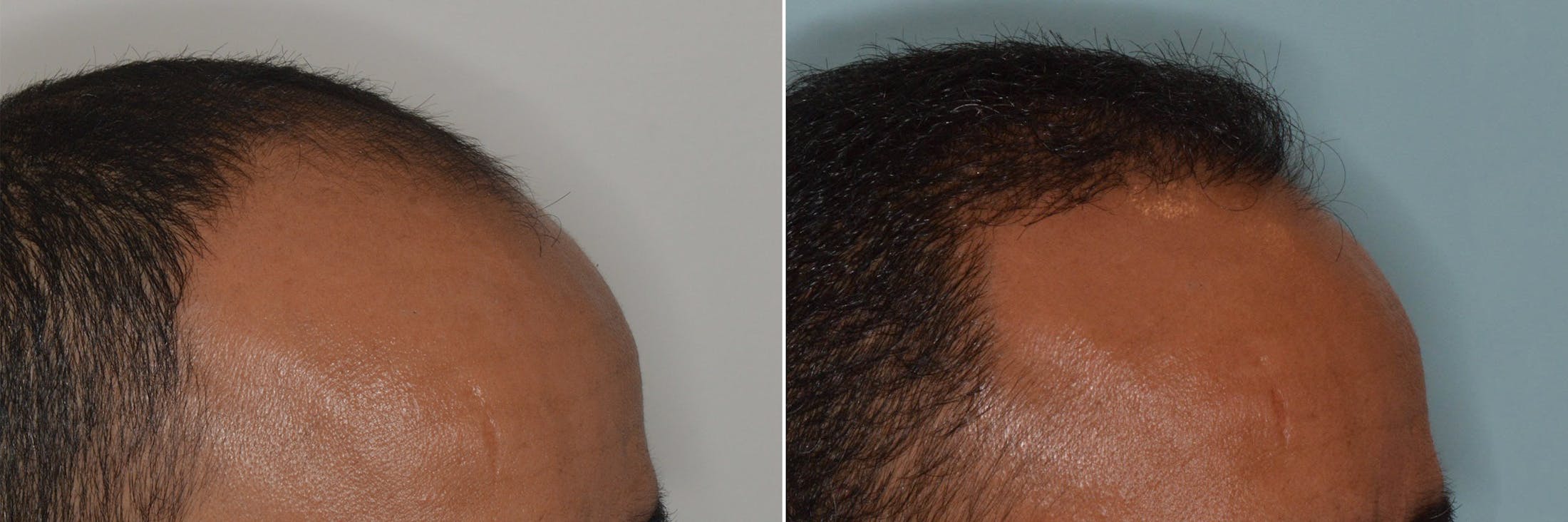 Hair Transplant before and after, oblique right.