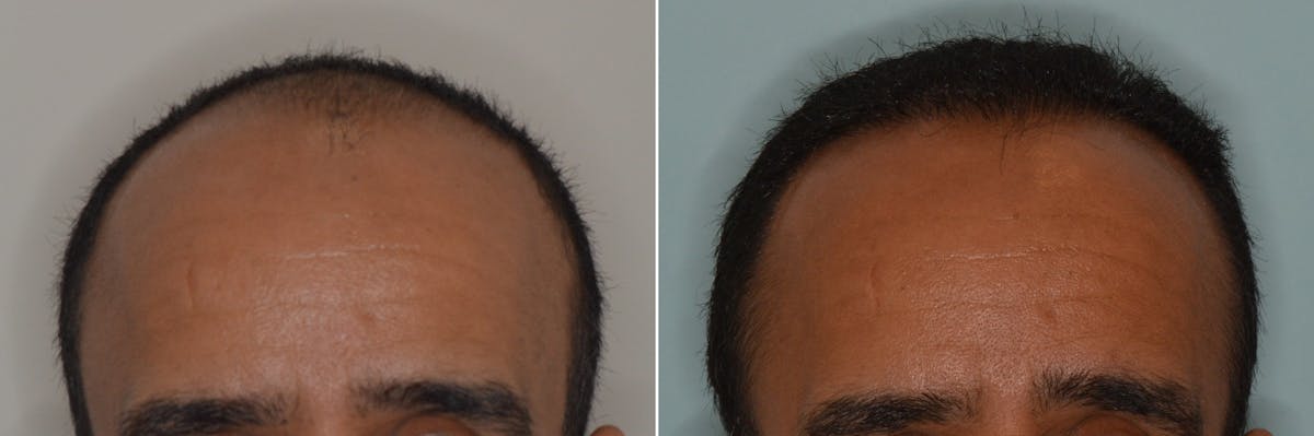 Hair Transplant before and after, frontal.