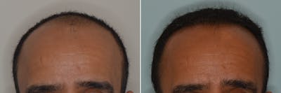 Hair Transplant before and after, frontal.